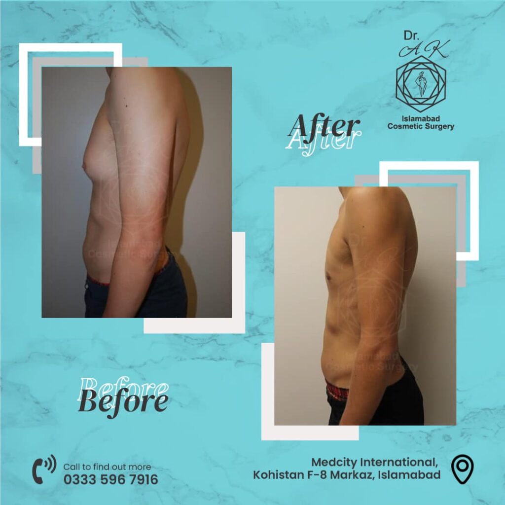 gynecomastia surgery islamabad