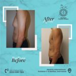 gynecomastia surgery islamabad
