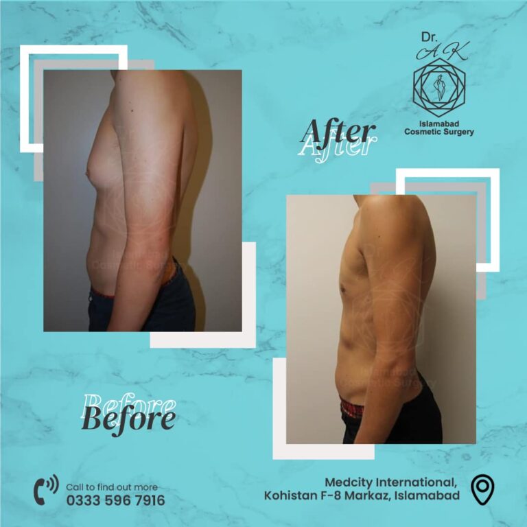 gynecomastia surgery islamabad
