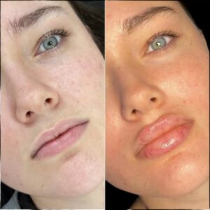 Under eye fillers