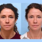 Best Doctors in Dubai for Professional and Modern Facial Thread Lift