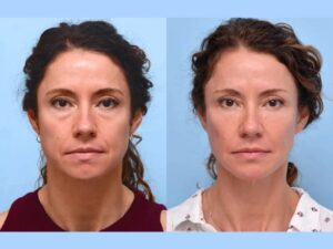 Best Doctors in Dubai for Professional and Modern Facial Thread Lift