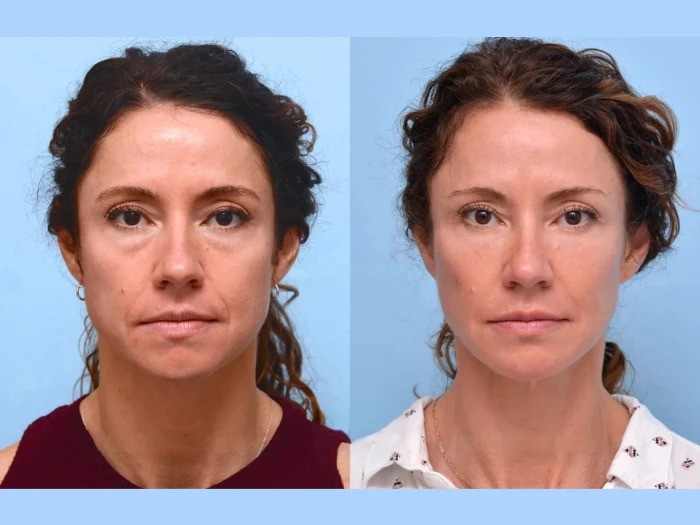 Best Doctors in Dubai for Professional and Modern Facial Thread Lift