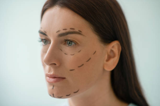 How Do Facelifts Reduce Wrinkles Fast