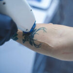 How Does Tattoo Color Affect the Success of Removal Treatment