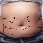 How Effective Is Lipo Abdominoplasty for Belly Fat