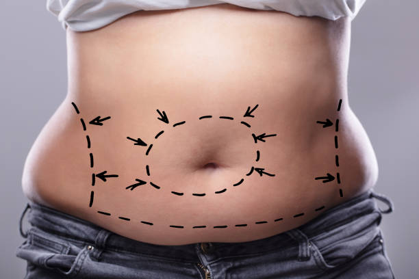 How Effective Is Lipo Abdominoplasty for Belly Fat