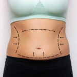 How Long Do Liposuction Results Really Last