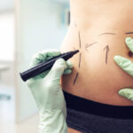 How Long Do Liposuction Results Typically Last