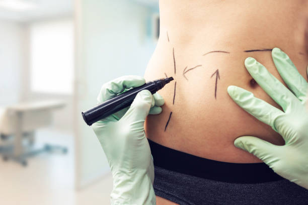 How Long Do Liposuction Results Typically Last