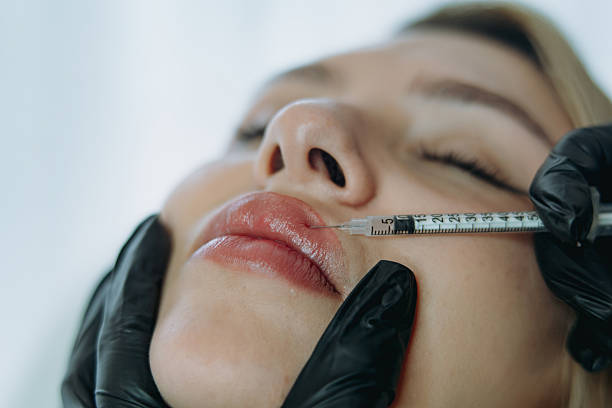 How Long Do Russian Lip Fillers Typically Last