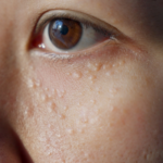 How Long Does Milia Treatment Take to Work