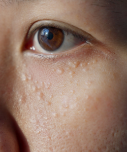 How Long Does Milia Treatment Take to Work