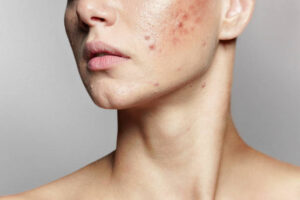 Is Acne Treatment Suitable for Dry Skin
