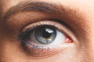 Is Eyelid Surgery Worth It for Eye Rejuvenation