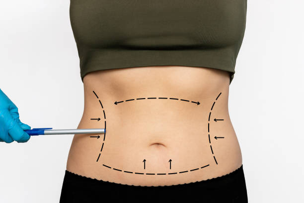 Is Mini Abdominoplasty Suitable for Minor Belly Fat