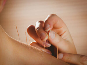 Acupuncture For Back Pain NYC/Grand Madison Acupuncture