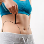 Liposuction in Dubai