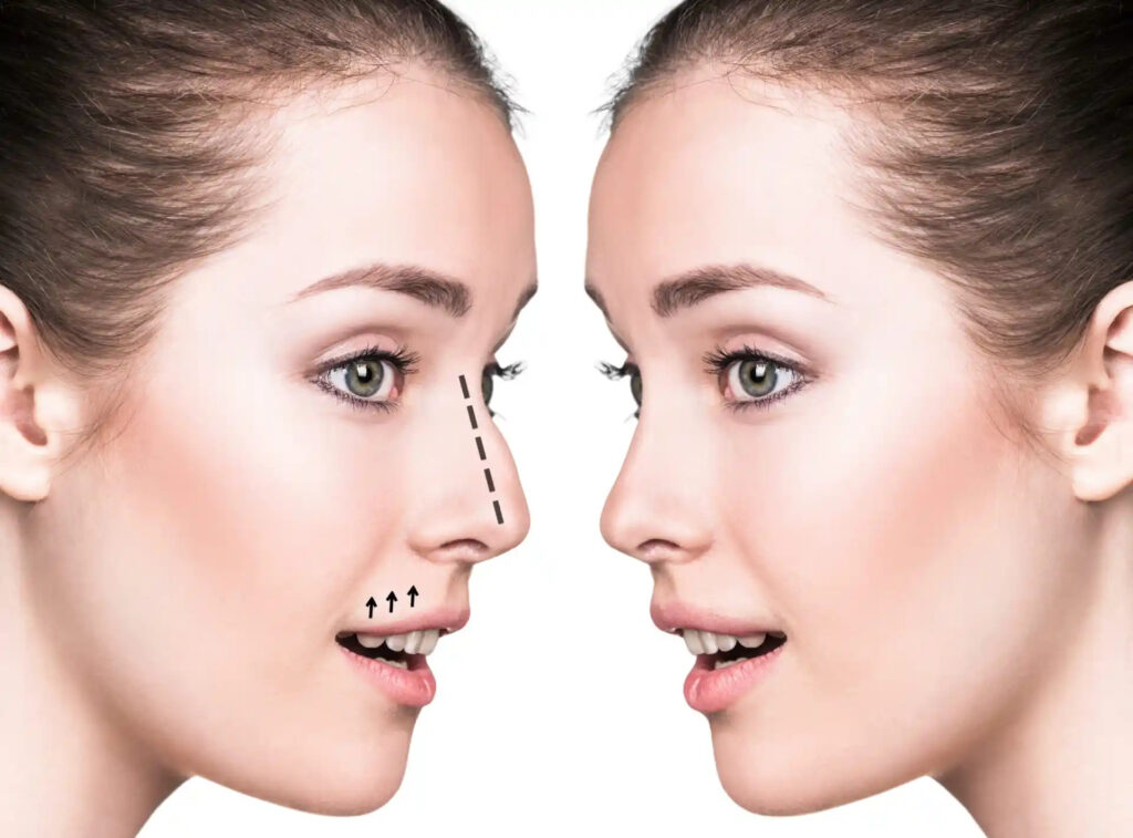 Rhinoplasty in Dubai