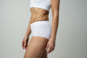 vaser Liposuction in Dubai