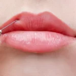 What Are the Benefits of Choosing Russian Lip Fillers