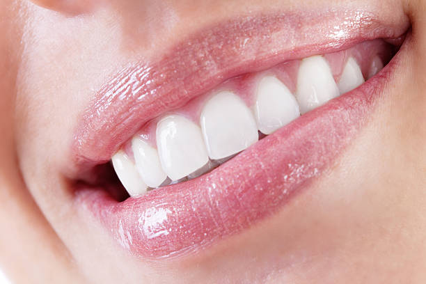 What Are the Benefits of E-Max Veneers