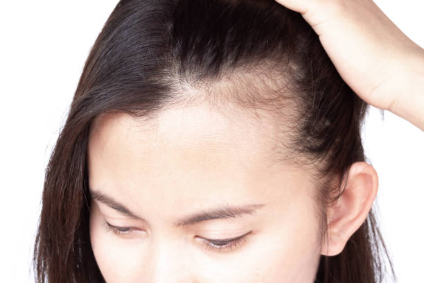 What Are the Benefits of Exosomes Hair Treatment