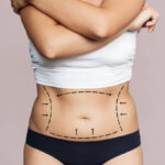 What Makes Liposuction Popular for Body Sculpting