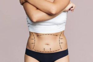 What Makes Liposuction Popular for Body Sculpting