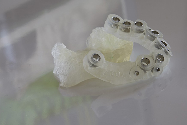 3D printed dental implant guide