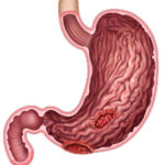 stomach-ulcers (4)