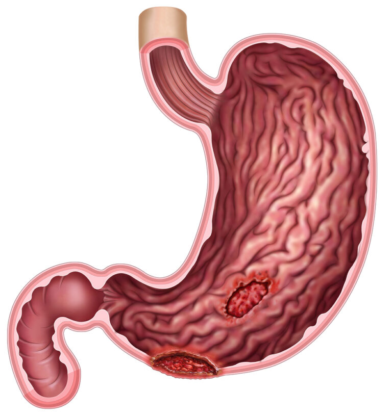 stomach-ulcers (4)