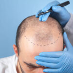 ما هي الآثار الجانبية لزراعة الشعر؟