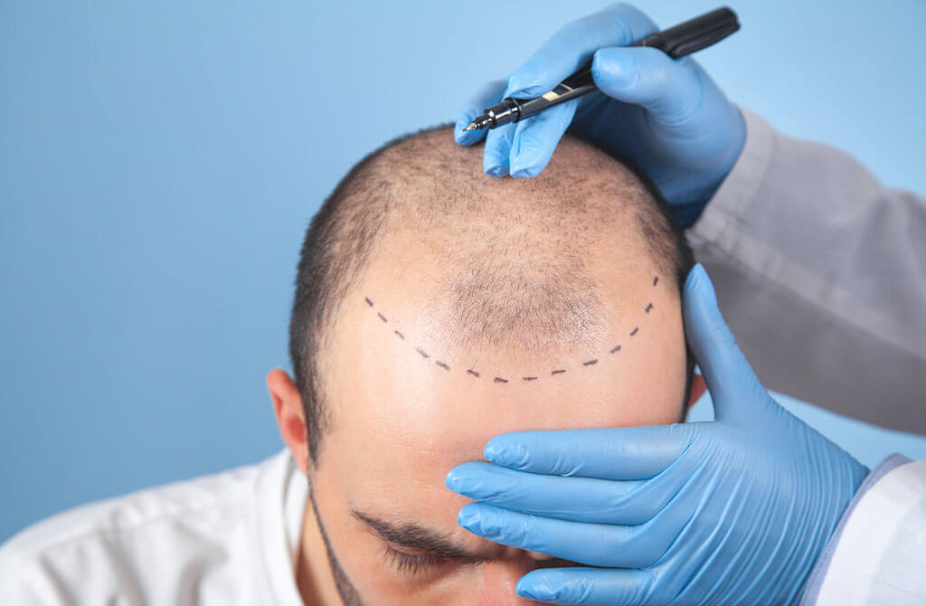 ما هي الآثار الجانبية لزراعة الشعر؟