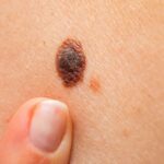 ما هي فترة النقاهة بعد إزالة آفات الجلد؟