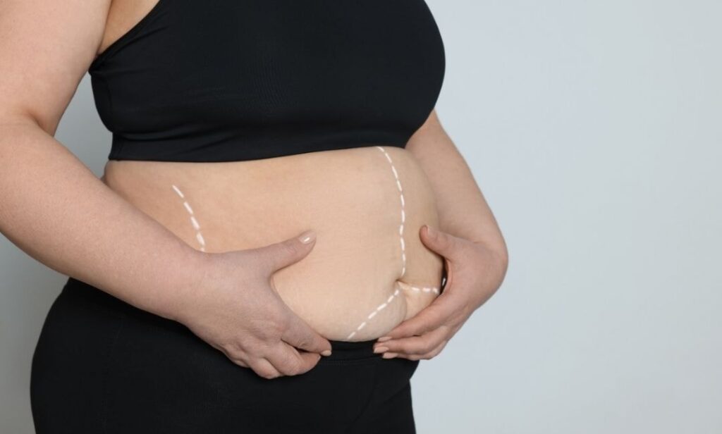 شفط الدهون بالليزر في أبو ظبي