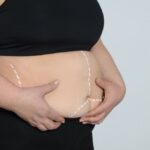 شفط الدهون بالليزر في أبو ظبي