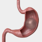 هل عملية تركيب بالون المعدة أفضل من الجراحة؟