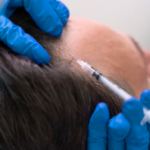 هل يدوم علاج ACell PRP لتساقط الشعر طويلًا؟