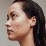 هل يستحق علاج حب الشباب الاحترافي التكلفة؟