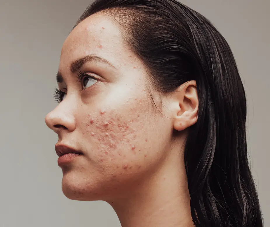 هل يستحق علاج حب الشباب الاحترافي التكلفة؟