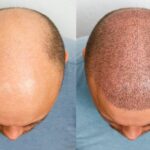 687787641d45e21a2c3d2dde_Hair Transplant-min