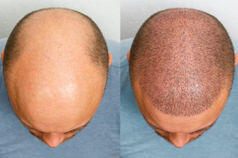 687787641d45e21a2c3d2dde_Hair Transplant-min