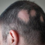 Can Hair Loss Treatment treat genetic baldness