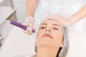 Can Microneedling Treat Large Open Pores Safely
