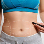 Can Tummy Tuck Fix Diastasis Recti Safely