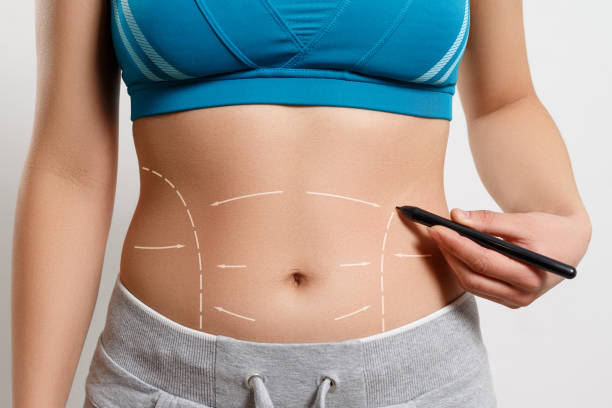 Can Tummy Tuck Fix Diastasis Recti Safely