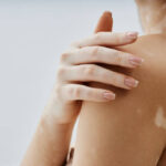 Can vitiligo treatment help facial patches