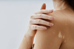Can vitiligo treatment help facial patches