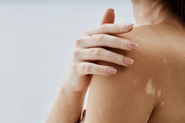 Can vitiligo treatment help facial patches